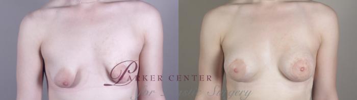 Correction of Tubular Breasts Case 971 Before & After Front | Paramus, NJ | Parker Center for Plastic Surgery