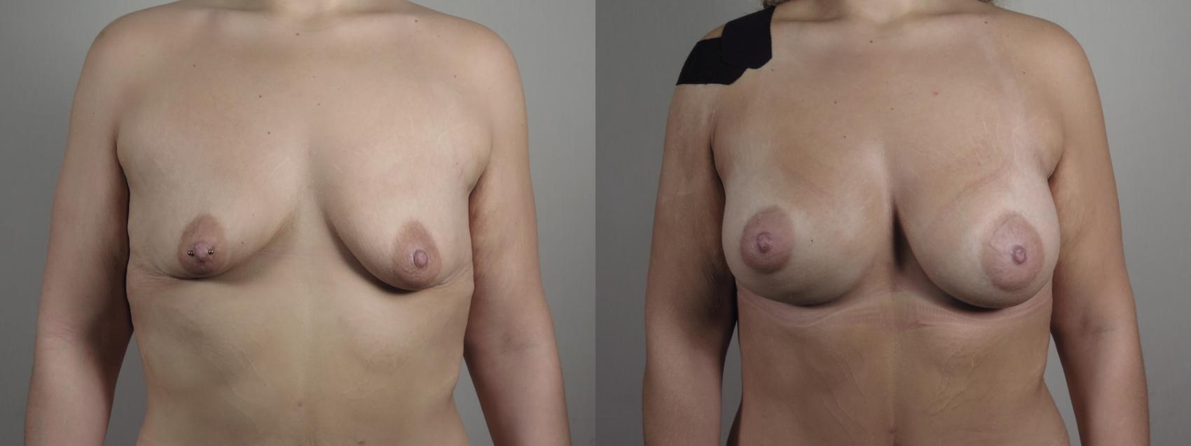 Breast Augmentation Case 992 Before & After Front breast | Paramus, NJ | Parker Center for Plastic Surgery