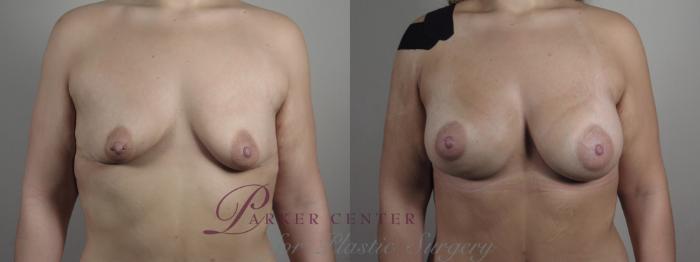 Breast Augmentation Case 992 Before & After Front breast | Paramus, NJ | Parker Center for Plastic Surgery