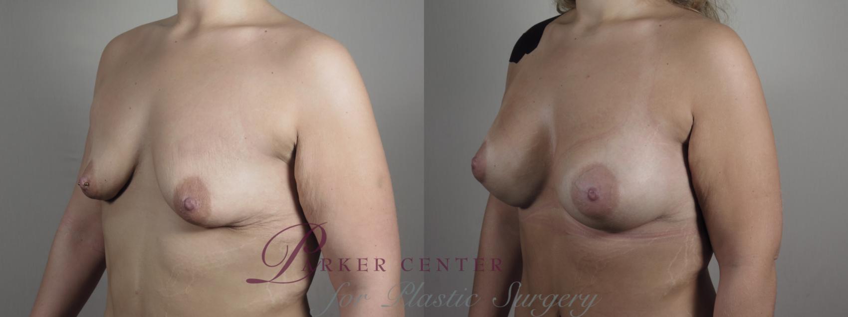 Breast Augmentation Case 992 Before & After Right Oblique | Paramus, NJ | Parker Center for Plastic Surgery