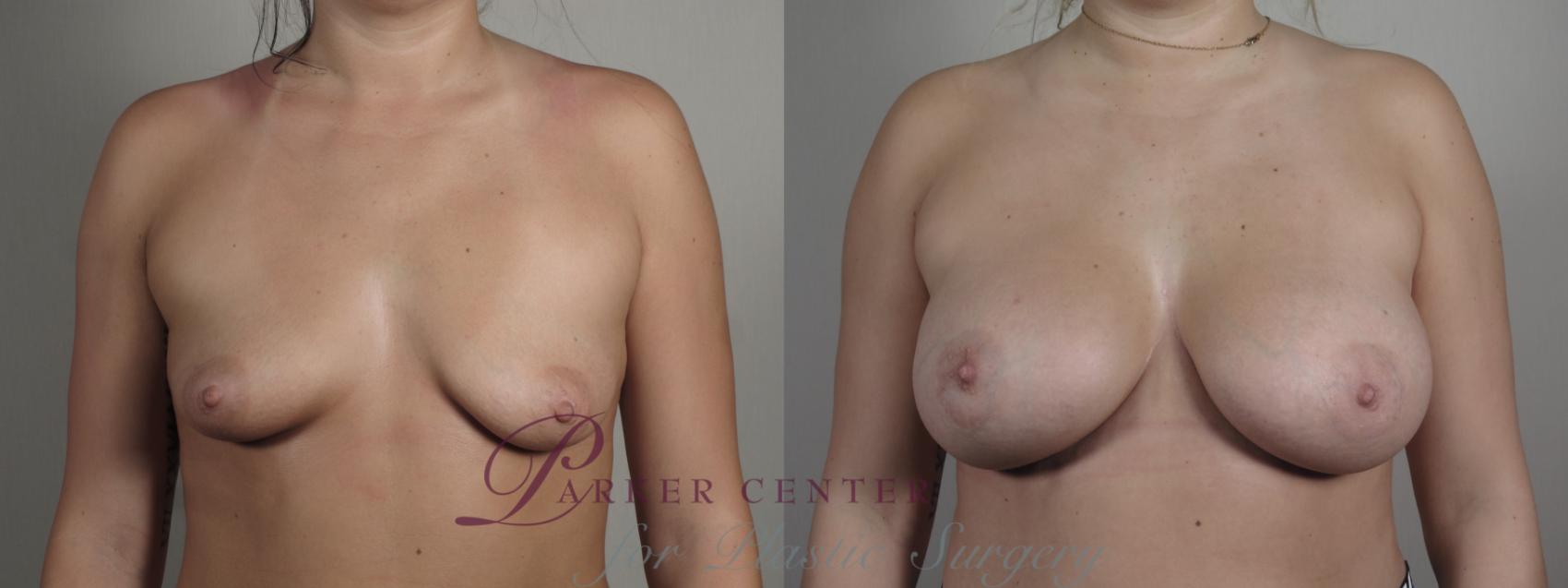 Breast Augmentation Case 993 Before & After Front | Paramus, NJ | Parker Center for Plastic Surgery