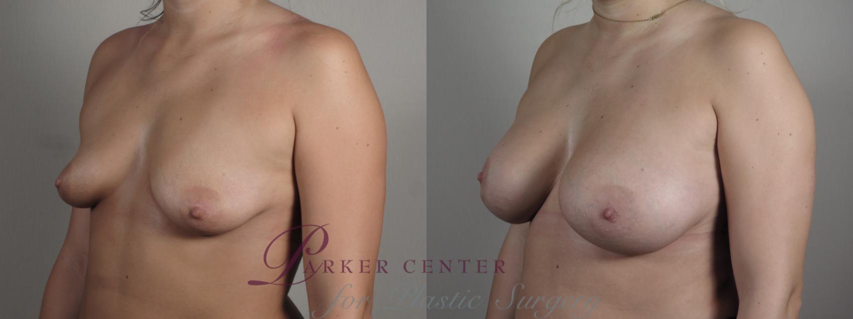 Breast Lift with Implants Case 993 Before & After Right Oblique | Paramus, NJ | Parker Center for Plastic Surgery