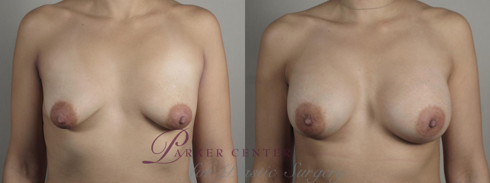 Breast Augmentation Case 994 Before & After Front | Paramus, NJ | Parker Center for Plastic Surgery