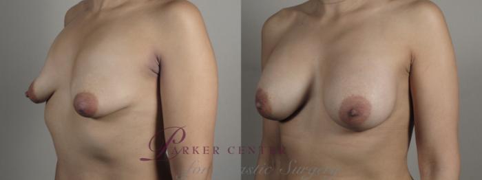 Breast Augmentation Case 994 Before & After Right Oblique | Paramus, NJ | Parker Center for Plastic Surgery