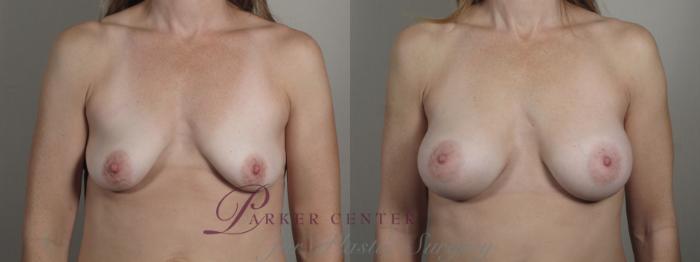 Breast Augmentation Case 995 Before & After Front | Paramus, NJ | Parker Center for Plastic Surgery