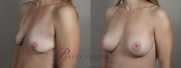 Breast Lift with Implants Case 995 Before & After Right Oblique | Paramus, NJ | Parker Center for Plastic Surgery