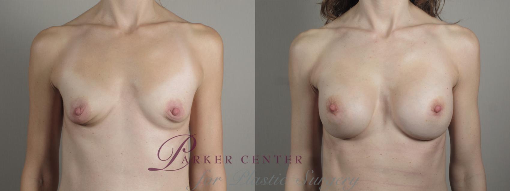 Breast Augmentation Case 996 Before & After Front | Paramus, NJ | Parker Center for Plastic Surgery