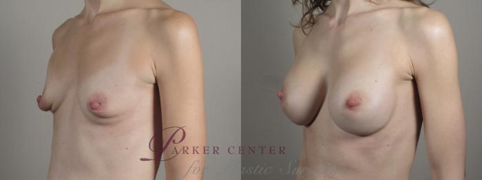 Breast Augmentation Case 996 Before & After Right Oblique | Paramus, NJ | Parker Center for Plastic Surgery
