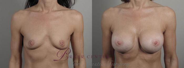 Breast Augmentation Case 997 Before & After Front | Paramus, NJ | Parker Center for Plastic Surgery