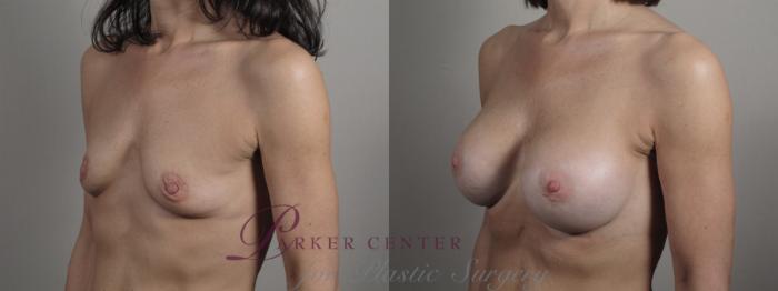 Breast Augmentation Case 997 Before & After Right Oblique | Paramus, NJ | Parker Center for Plastic Surgery