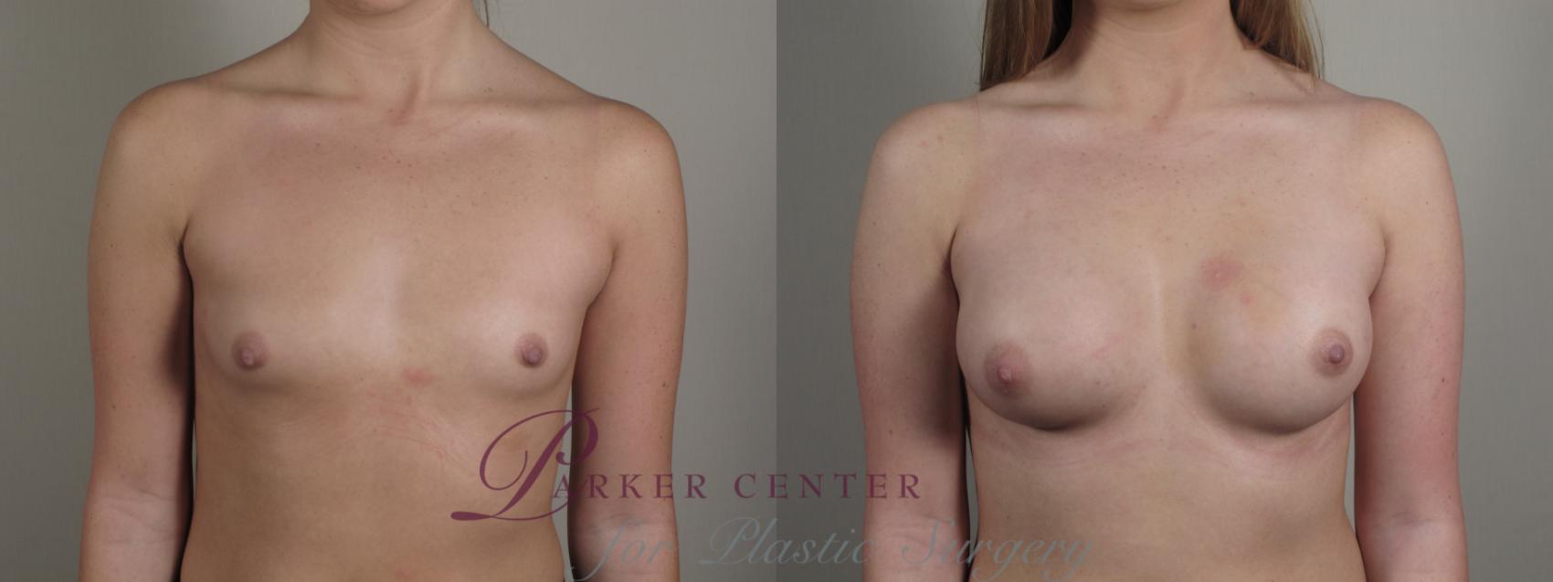 Breast Augmentation Case 998 Before & After Front | Paramus, NJ | Parker Center for Plastic Surgery
