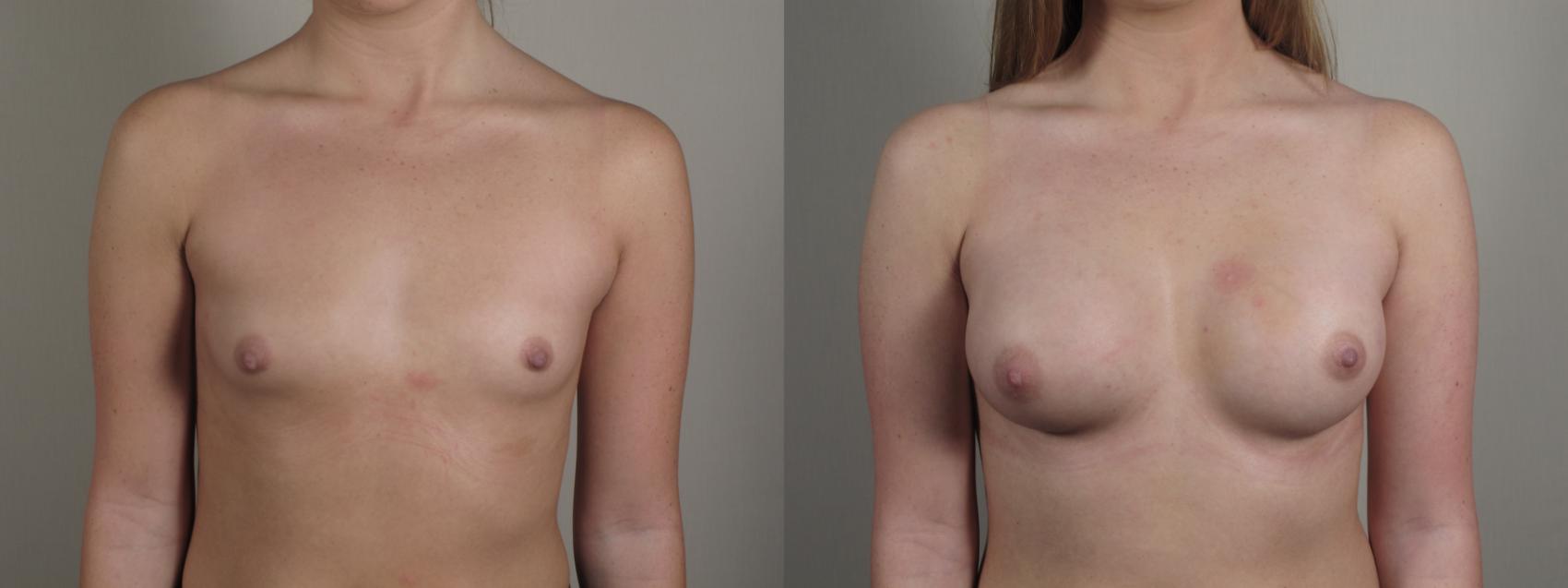 Breast Augmentation Case 998 Before & After Front | Paramus, NJ | Parker Center for Plastic Surgery