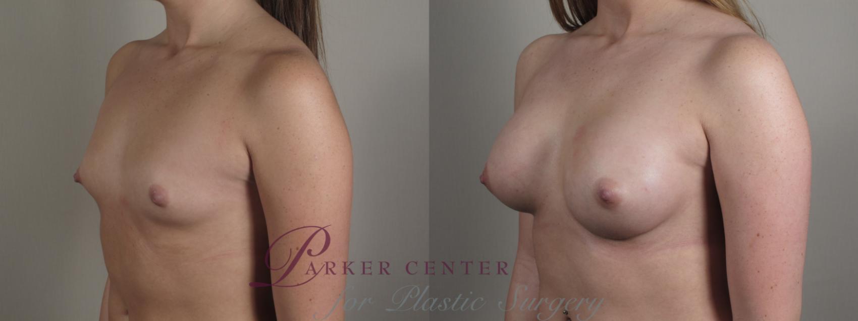 Breast Augmentation Case 998 Before & After Right Oblique | Paramus, NJ | Parker Center for Plastic Surgery