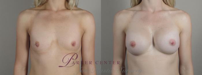 Breast Augmentation Case 999 Before & After Front | Paramus, NJ | Parker Center for Plastic Surgery