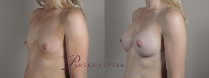 Breast Augmentation Case 999 Before & After Right Oblique | Paramus, NJ | Parker Center for Plastic Surgery
