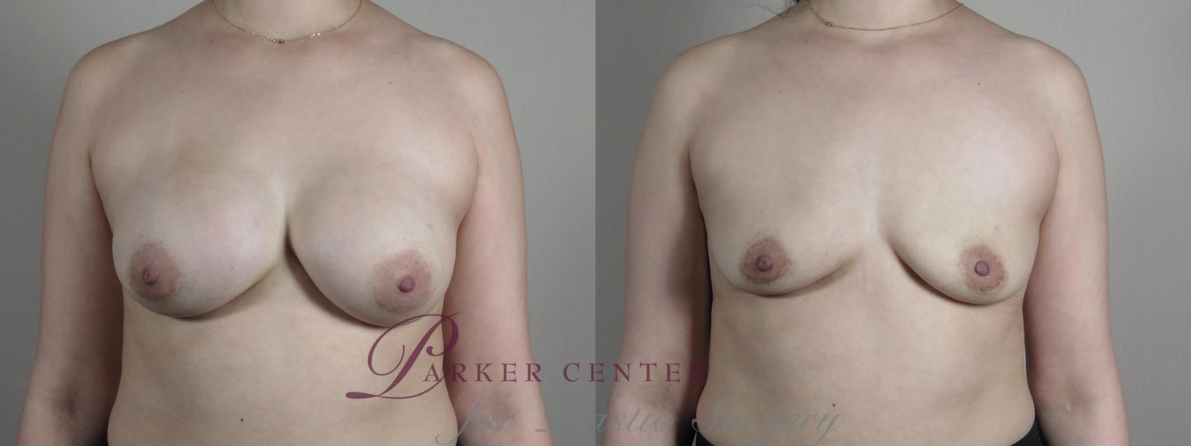 Breast Implant Removal Case 1026 Before & After Front | Paramus, NJ | Parker Center for Plastic Surgery