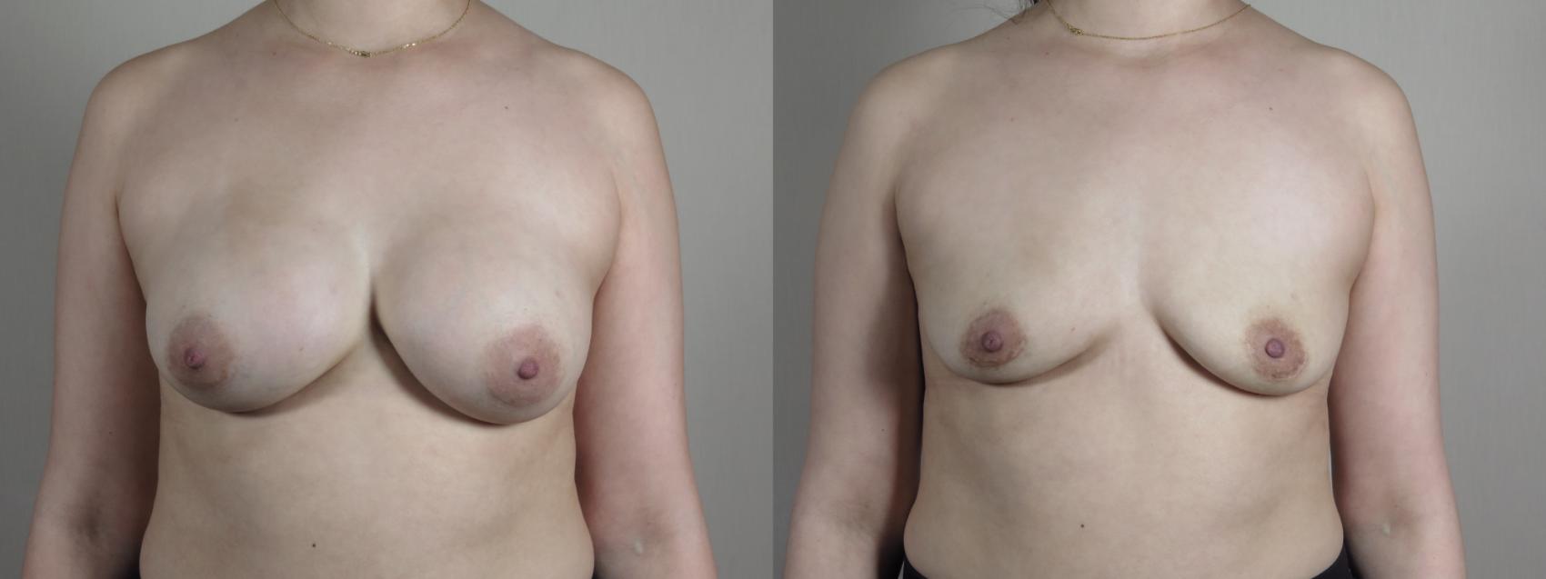 Breast Implant Removal Case 1026 Before & After Front | Paramus, NJ | Parker Center for Plastic Surgery