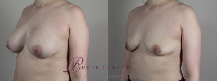Breast Implant Removal Case 1026 Before & After Right Oblique | Paramus, NJ | Parker Center for Plastic Surgery