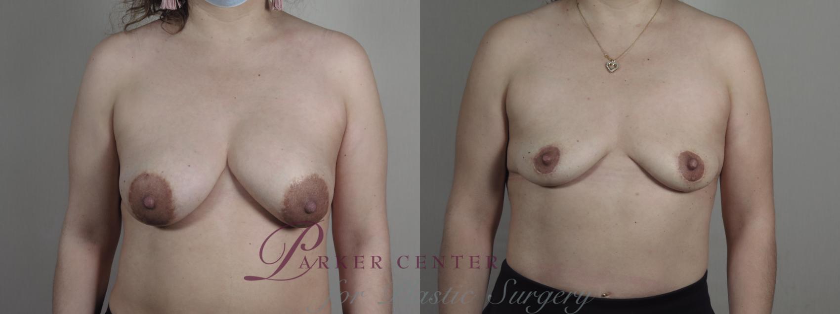 Breast Implant Removal Case 1195 Before & After View #1  | Paramus, NJ | Parker Center for Plastic Surgery