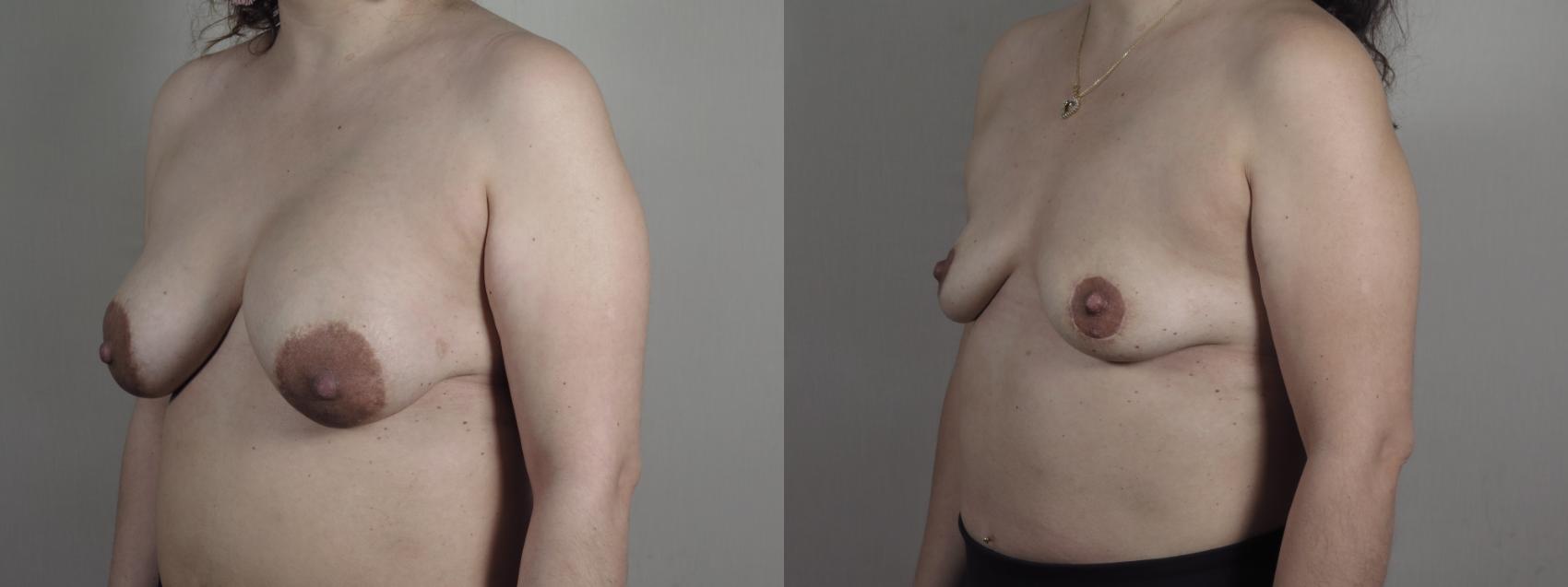 Breast Implant Removal Case 1195 Before & After View #2 | Paramus, NJ | Parker Center for Plastic Surgery