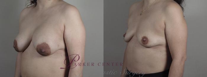 Breast Implant Removal Case 1195 Before & After View #2 | Paramus, NJ | Parker Center for Plastic Surgery