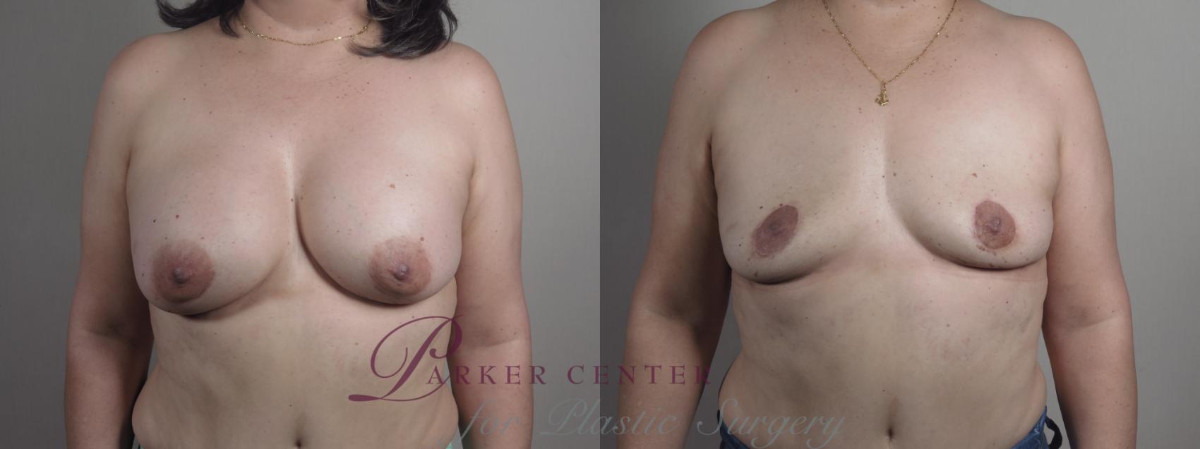 Breast Implant Removal Case 1196 Before & After View #1  | Paramus, NJ | Parker Center for Plastic Surgery