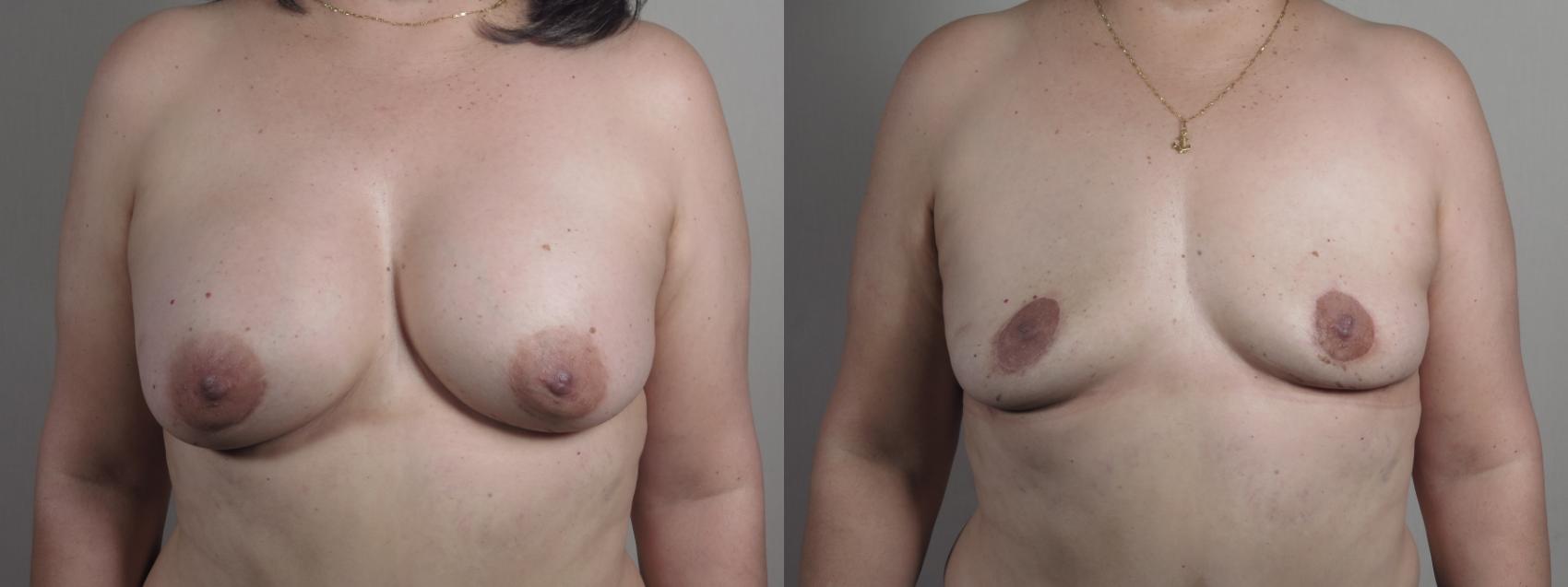 Breast Implant Removal Case 1196 Before & After View #1  | Paramus, New Jersey | Parker Center for Plastic Surgery