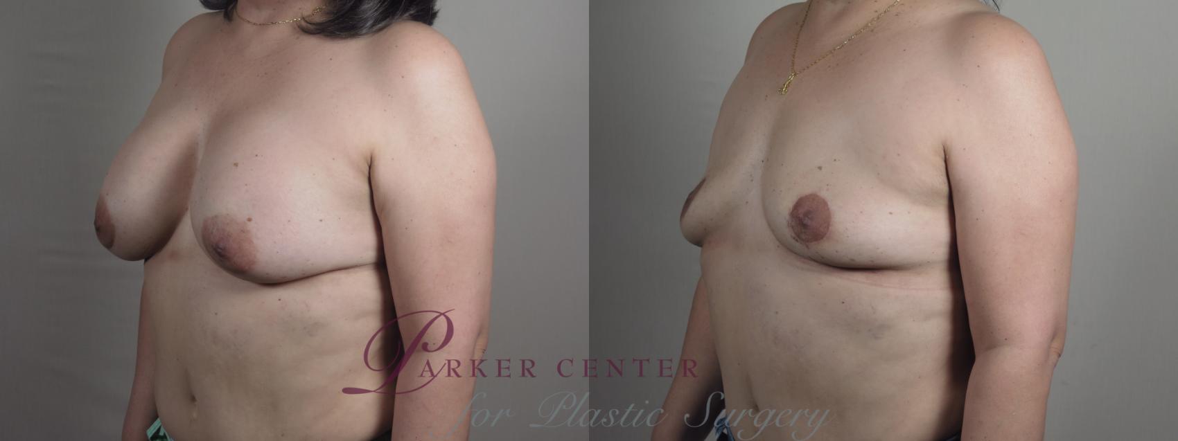 Breast Implant Removal Case 1196 Before & After View #2 | Paramus, NJ | Parker Center for Plastic Surgery