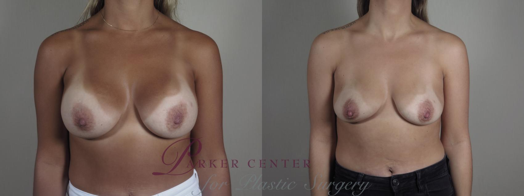 Breast Implant Removal Case 1197 Before & After View #1  | Paramus, NJ | Parker Center for Plastic Surgery