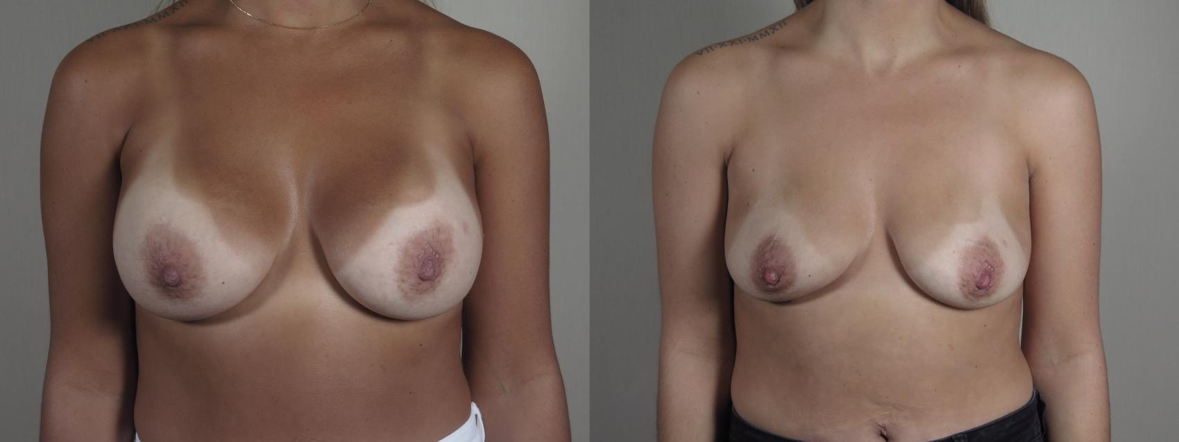 Breast Implant Removal Case 1197 Before & After View #1  | Paramus, New Jersey | Parker Center for Plastic Surgery