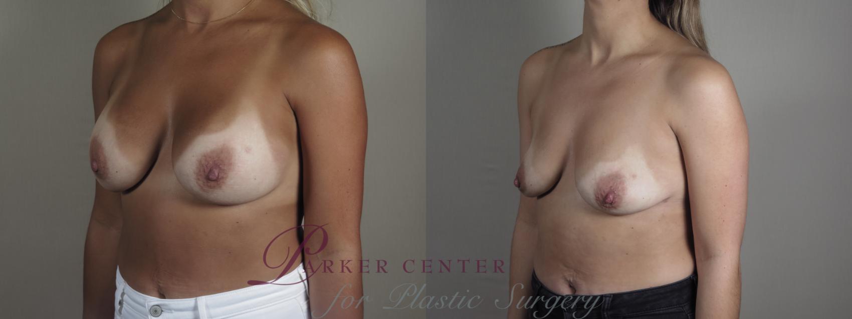 Breast Implant Removal Case 1197 Before & After View #2 | Paramus, NJ | Parker Center for Plastic Surgery