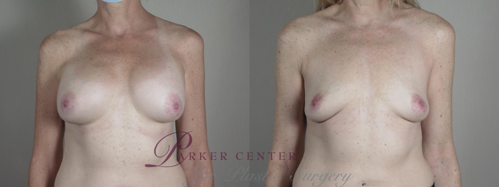 Breast Implant Removal Case 1216 Before & After View #1  | Paramus, NJ | Parker Center for Plastic Surgery
