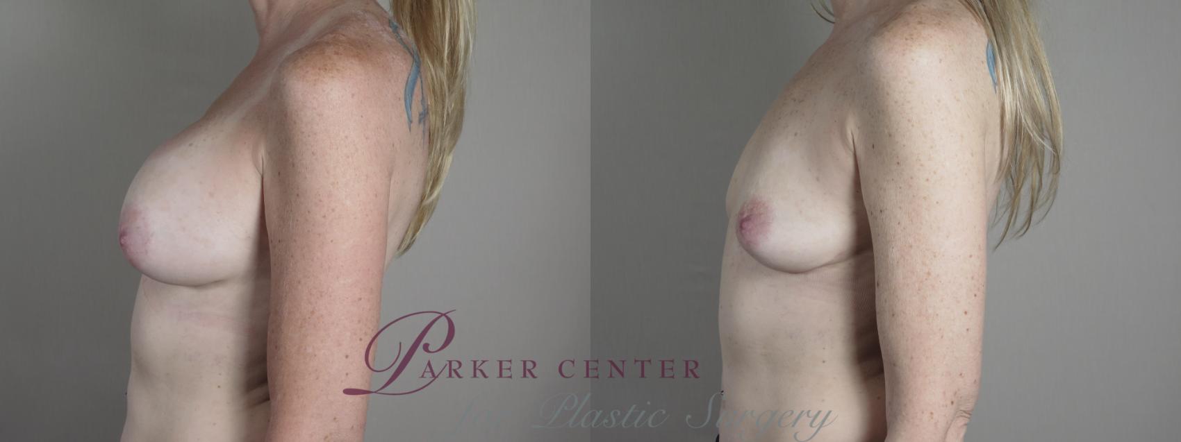 Breast Implant Removal Case 1216 Before & After View #2 | Paramus, NJ | Parker Center for Plastic Surgery