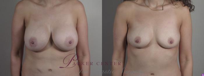 Breast Implant Removal Case 1237 Before & After Front | Paramus, NJ | Parker Center for Plastic Surgery