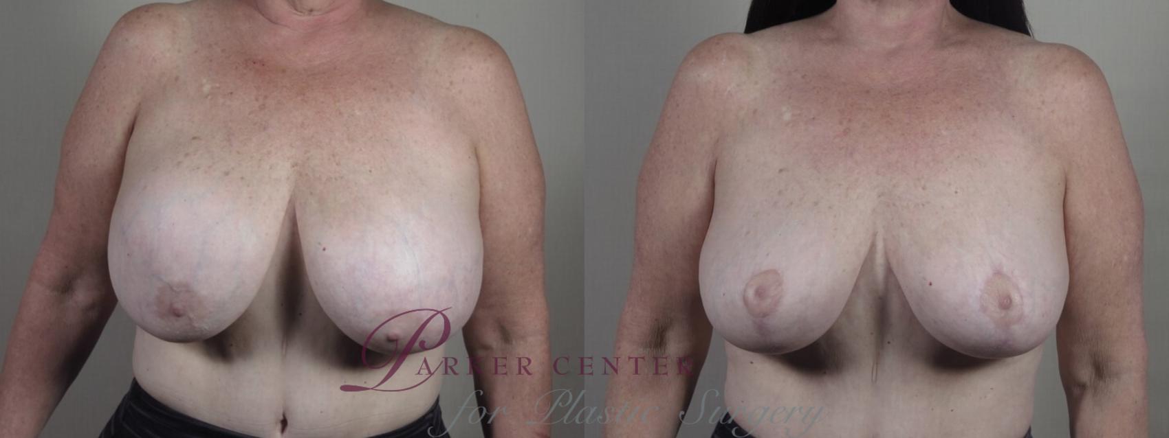 Breast Implant Removal Case 1239 Before & After Front | Paramus, NJ | Parker Center for Plastic Surgery
