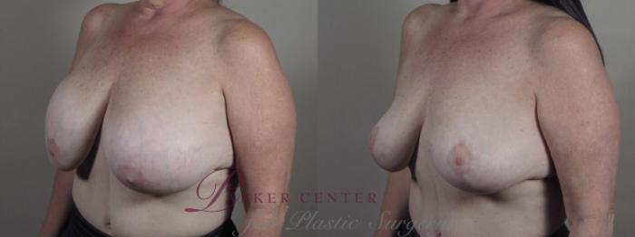 Breast Implant Removal Case 1239 Before & After Left Side | Paramus, NJ | Parker Center for Plastic Surgery