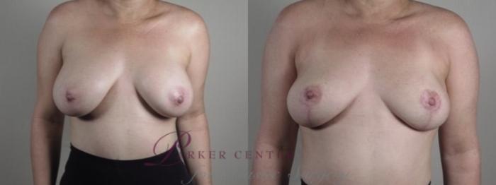 Breast Implant Removal Case 1244 Before & After Front | Paramus, NJ | Parker Center for Plastic Surgery