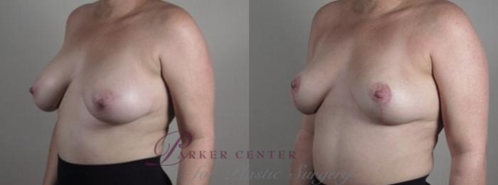 Breast Implant Removal Case 1244 Before & After Left Oblique | Paramus, NJ | Parker Center for Plastic Surgery