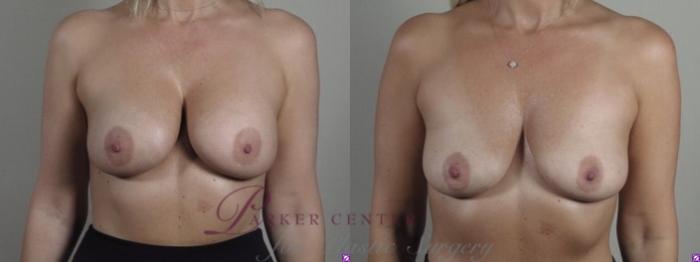 Breast Implant Removal Case 1245 Before & After Front | Paramus, NJ | Parker Center for Plastic Surgery