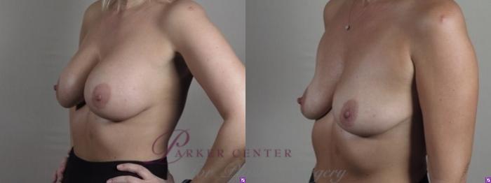 Breast Implant Removal Case 1245 Before & After Left Oblique | Paramus, NJ | Parker Center for Plastic Surgery
