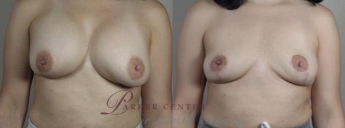 Breast Implant Removal Case 1246 Before & After Front | Paramus, NJ | Parker Center for Plastic Surgery