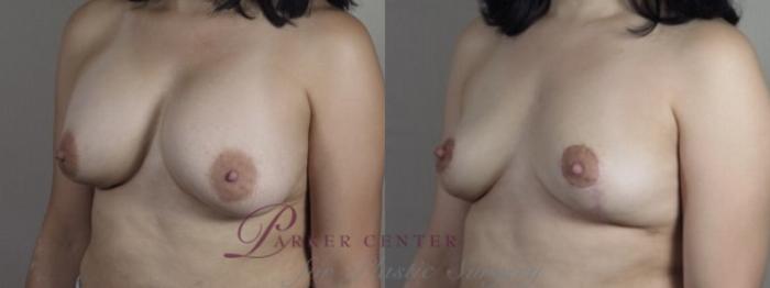 Breast Implant Removal Case 1246 Before & After Left Oblique | Paramus, NJ | Parker Center for Plastic Surgery