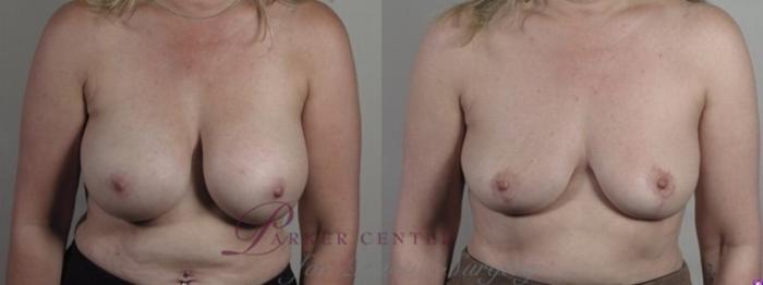 Breast Implant Removal Case 1248 Before & After Front | Paramus, NJ | Parker Center for Plastic Surgery