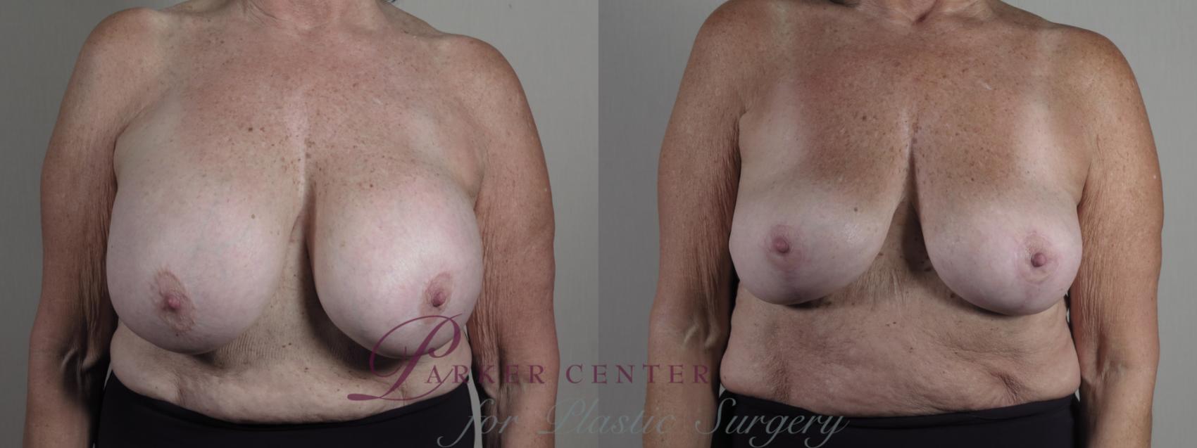 Breast Implant Removal Case 1268 Before & After Front | Paramus, NJ | Parker Center for Plastic Surgery