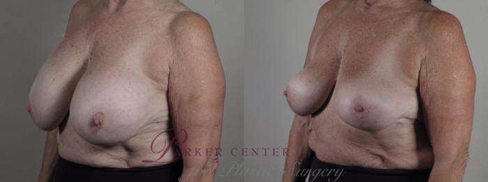 Breast Implant Removal Case 1268 Before & After Left Oblique | Paramus, NJ | Parker Center for Plastic Surgery