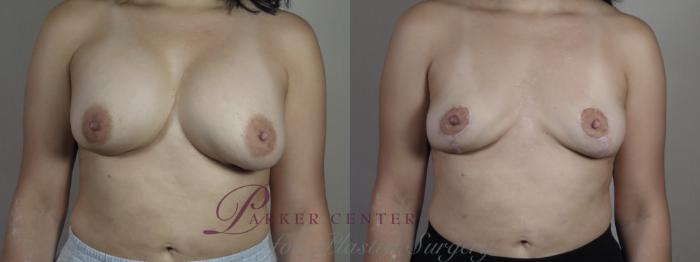 Breast Implant Removal Case 1278 Before & After Front | Paramus, NJ | Parker Center for Plastic Surgery
