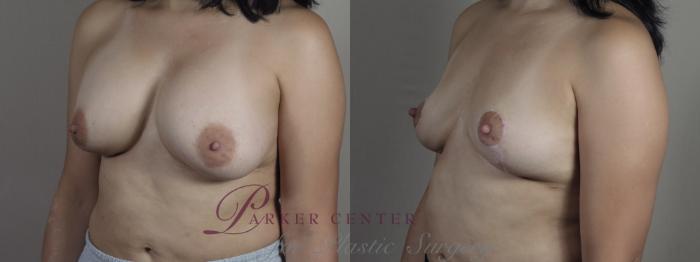 Breast Implant Removal Case 1278 Before & After Left Oblique | Paramus, NJ | Parker Center for Plastic Surgery