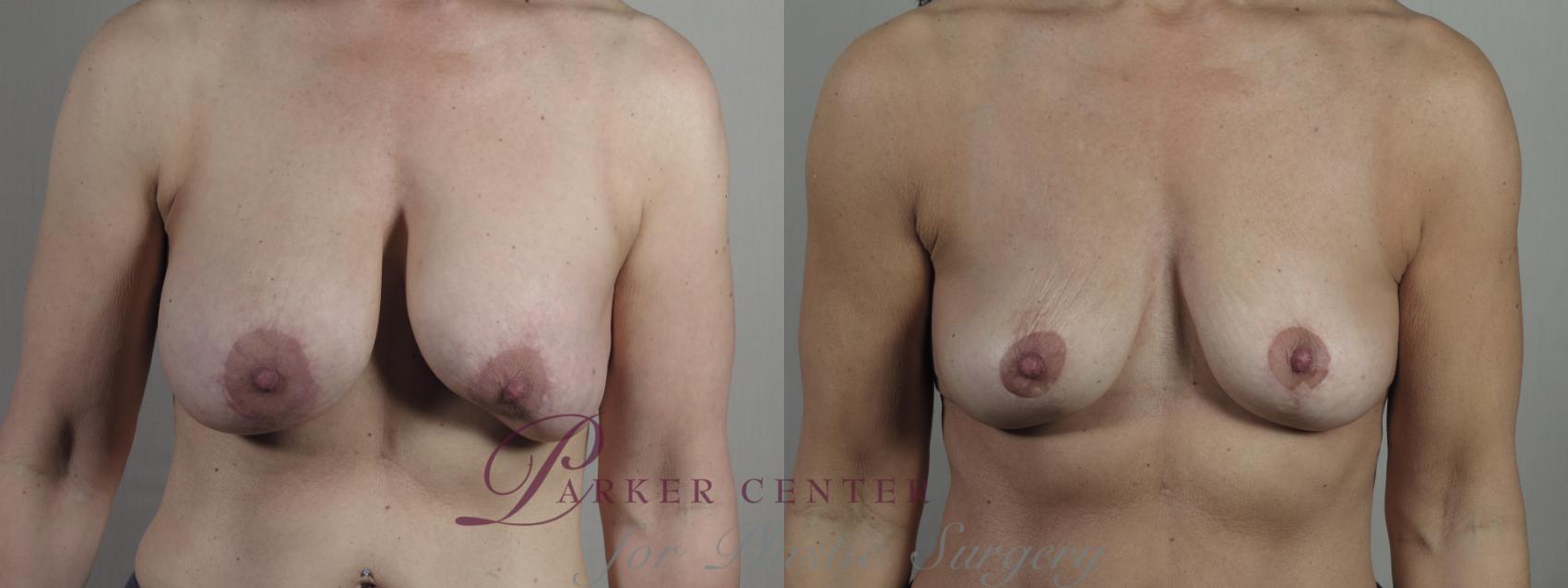 Breast Implant Removal Case 1344 Before & After Front | Paramus, NJ | Parker Center for Plastic Surgery