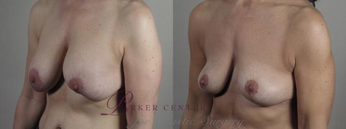 Breast Implant Removal Case 1344 Before & After Left Oblique | Paramus, NJ | Parker Center for Plastic Surgery