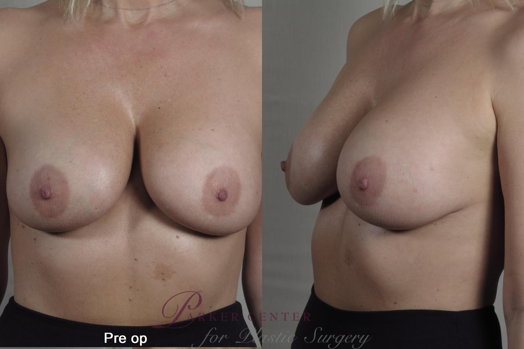 Breast Implant Removal Case 1359 Before & After pre op  | Paramus, New Jersey | Parker Center for Plastic Surgery